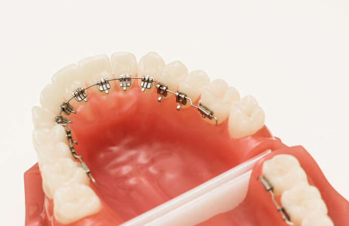 歯の裏側で見えない 裏側矯正